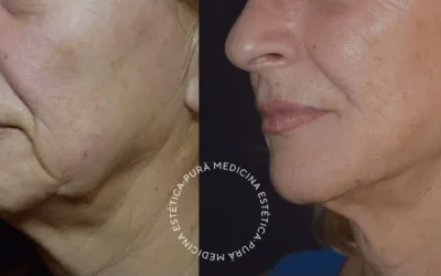 Redescubre tu Belleza con Morpheus8 en Málaga